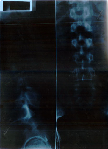 Spine X-Ray